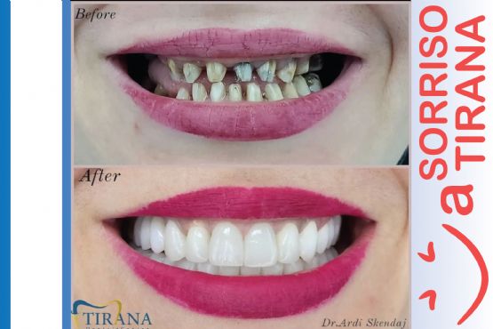 Terapi / Terapi dentare / mbushje dhembi / terapi kanalare / terapi endo / terapi endodonti / pastrim i gurezave stomatolog per femije / dental smile clinic in tirana / estetik dentare / estetik dhe higjien dentare / Luna Dental Clinic